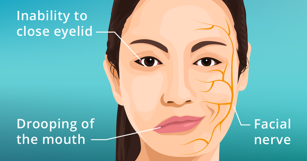 The Truth About Bell's Palsy
